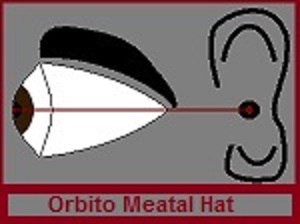 Orbito Meatal Hat