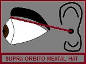 Supra Orbito Meatal Hat