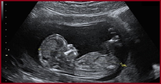 Ultrason Anne yada Bebek İçin Zararlı mı