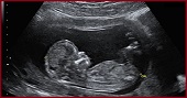 Ultrason Anne yada Bebek İçin Zararlı mı ?