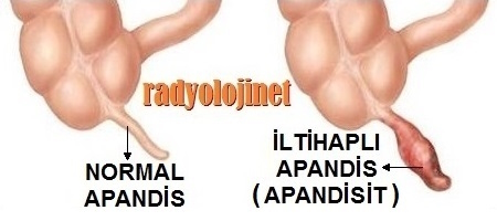 Normal Apandis - İltihapli Apandis