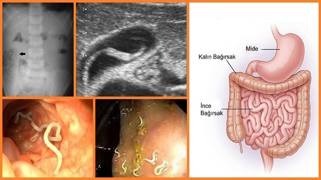 Bağırsak Parazitleri