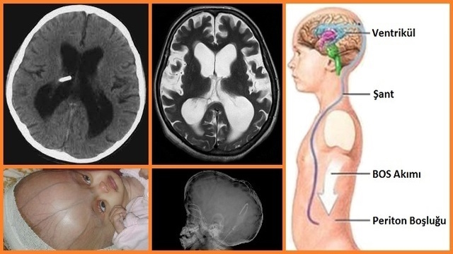 Hidrosefali - Beyinde Su Toplanması