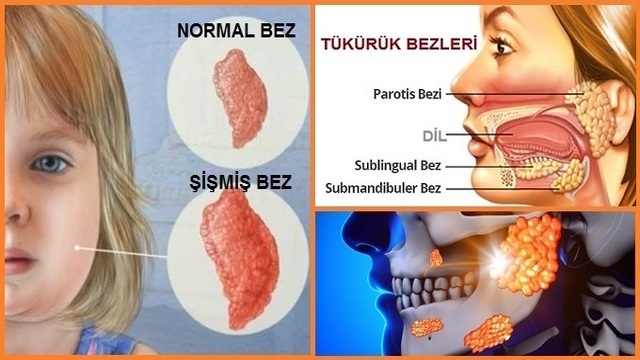 Kabakulak - Mumps - Epidemik Parotitis