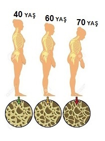 Yaş İlerledikçe Kemik Yapısı