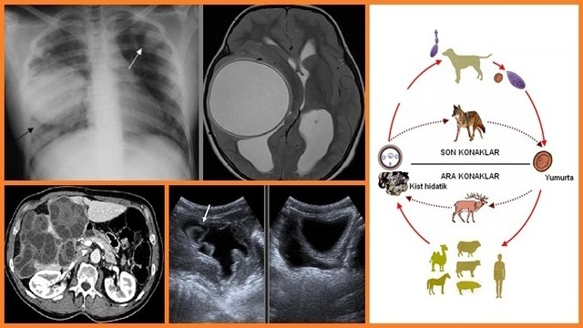 Kist Hidatik - Kistik Ekinokokkoz