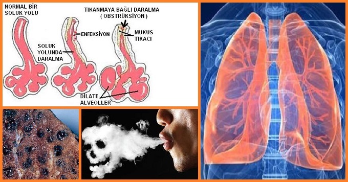 KOAH - Kronik Obstrüktif Akciğer Hastalığı