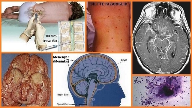 Menenjit - Beyin Zarı İltihabı