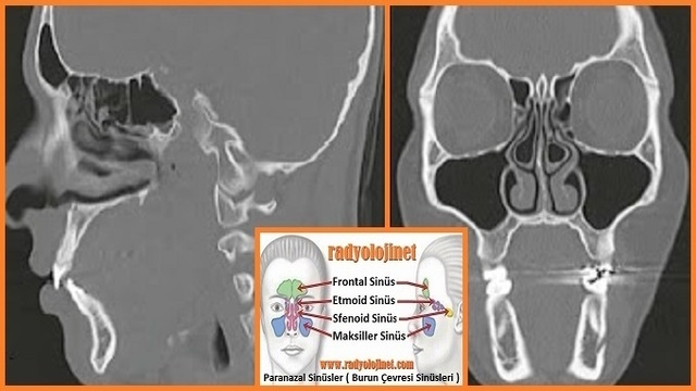 Paranazal Sinüsler