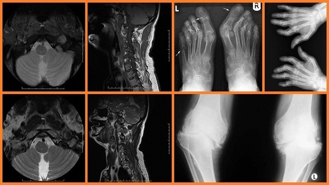 Romatoid Artrit - İltihaplı Romatizma