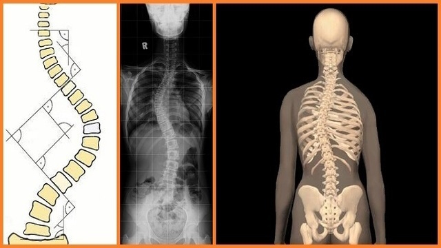 Skolyoz - Omurga Eğriliği