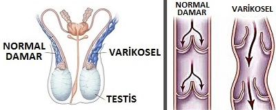 Normal Damar - Varikosel