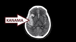 Travmaya Bağlı Beyin Kanaması BT Görüntüleri