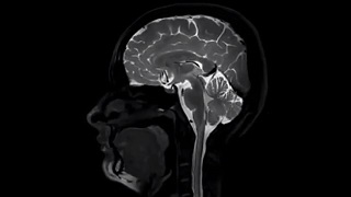 İntratekal Kontrastlı Beyin MR 2.Saat Yağ Baskılı 3D T1 Sagittal Görüntüsü